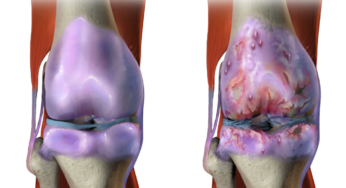 طب وجراحة العظام والمفاصل كيف تغيرت؟ وأين أصبحت بعد ثورة العلاج بالخلايا الجذعية العلاجية (المحفزة) المستخرجة من دهون الجسم؟